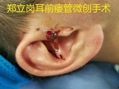 成人垂耳手术视频